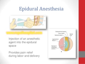 ainless delivery (Epidural anesthesia) 